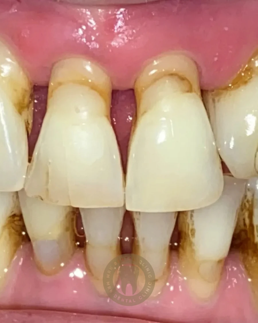 Periodontal Hastalık Tedavisi