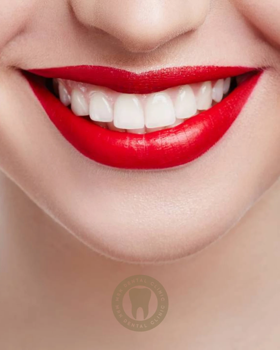 Hollywood Gülümsemesi